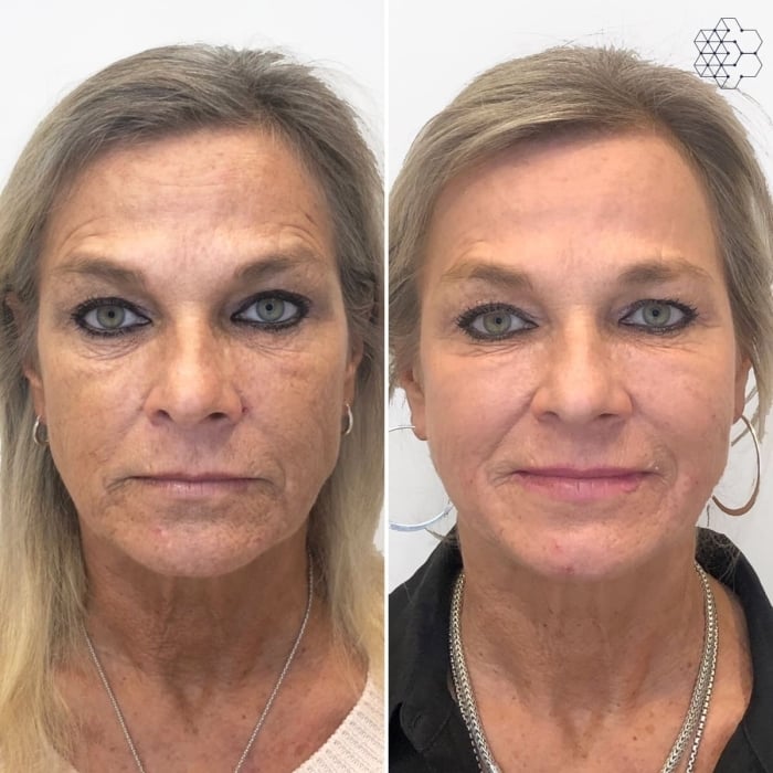 HALO™ Fractional Resurfacing