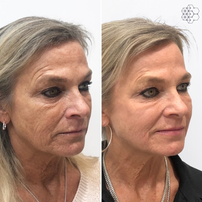 Sculptra®