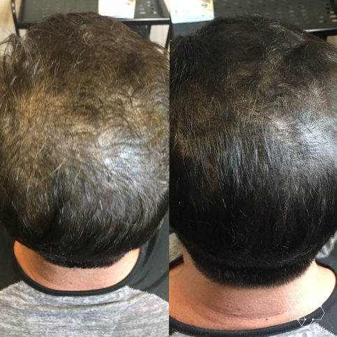 PRP Hair Restoration