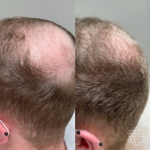 PRP Hair Restoration