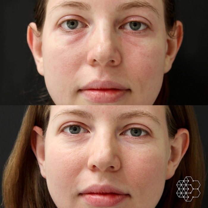 HALO™ Fractional Resurfacing