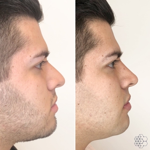 Non Surgical Nose Job