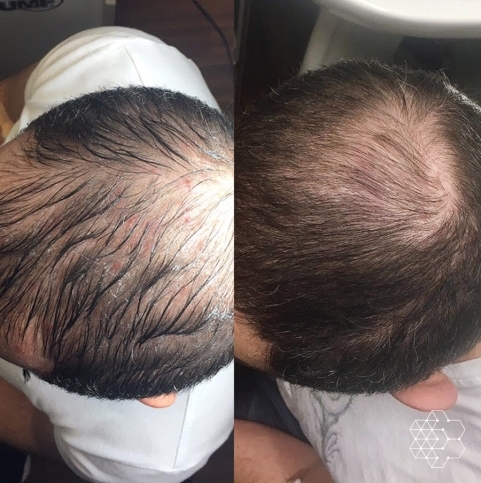 PRP Hair Restoration