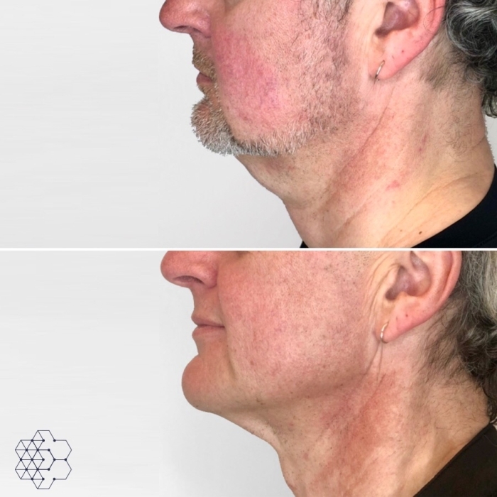 Double Chin Treatment