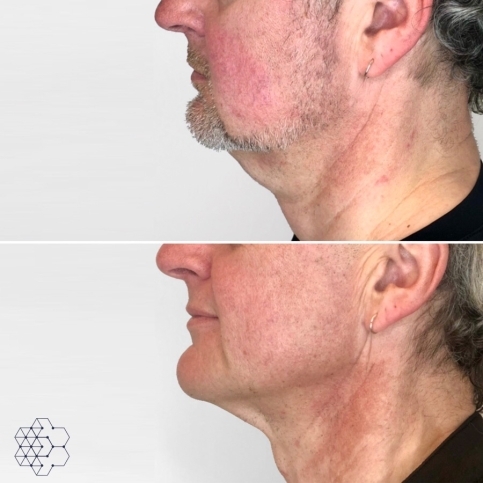 Double Chin Treatment