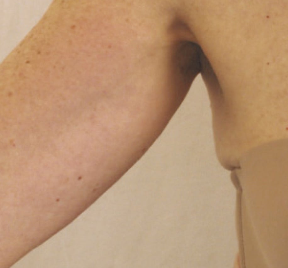 Skin Tightening & Body Contouring