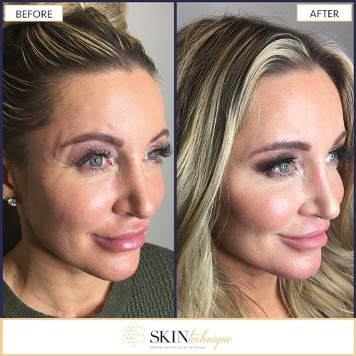 Cheek Lift by Dr. Pavlou