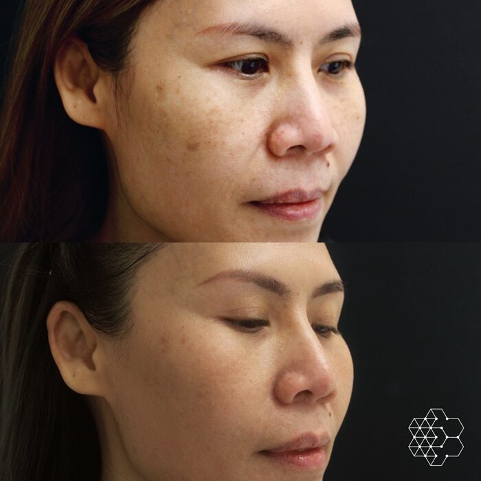Combination of Microneedling, Halo Fractional Resurfacing and Forever Young BBL
