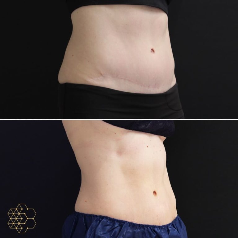CoolSculpting