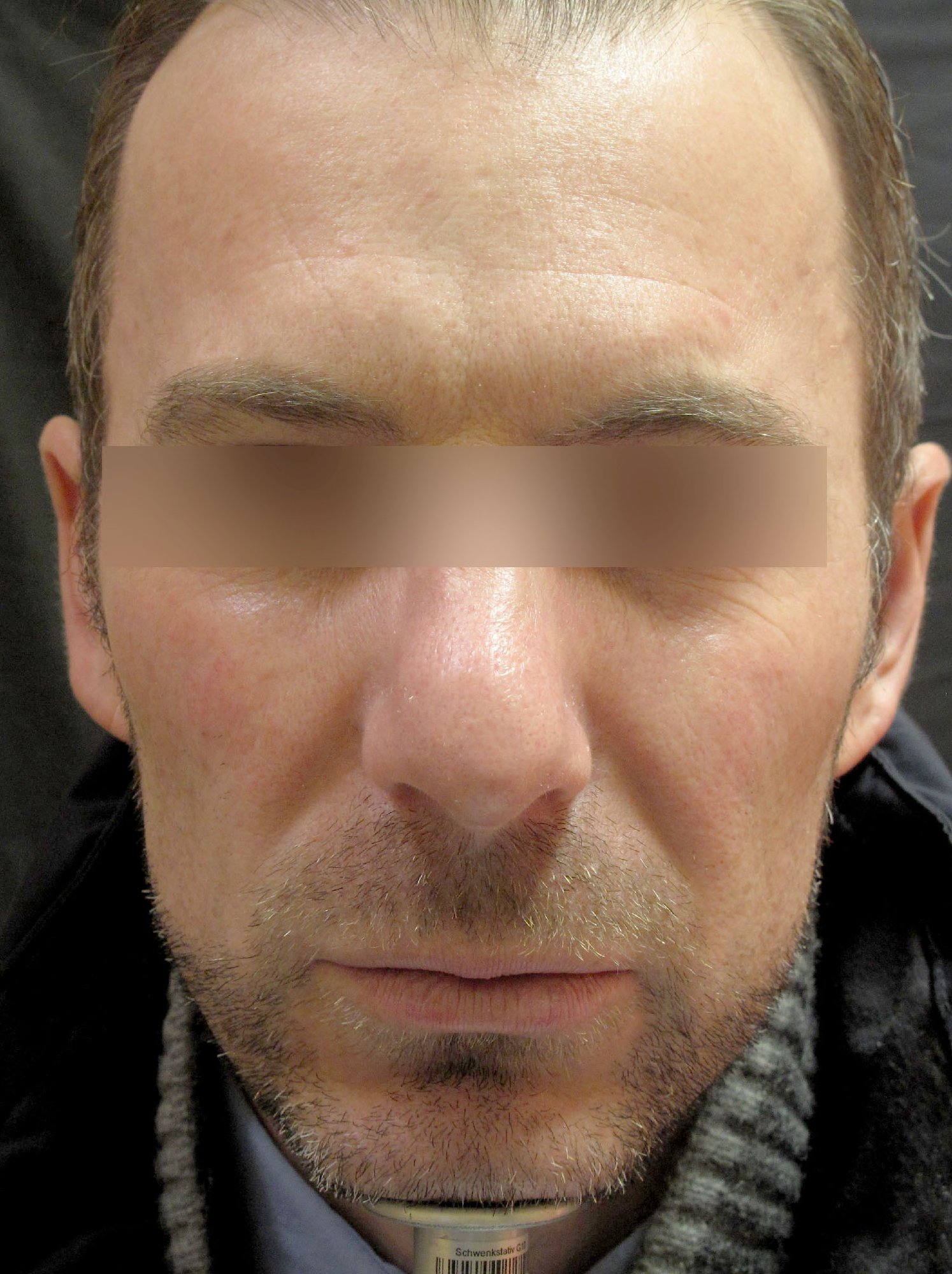 Frown Lines Correction