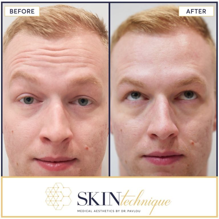 Forehead Lines Correction