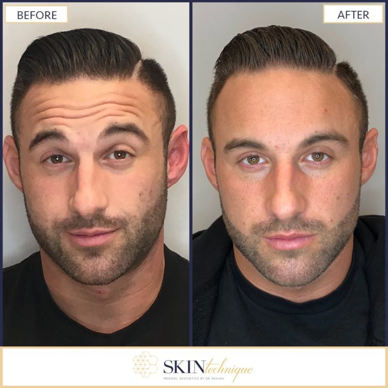 Forehead Lines Correction