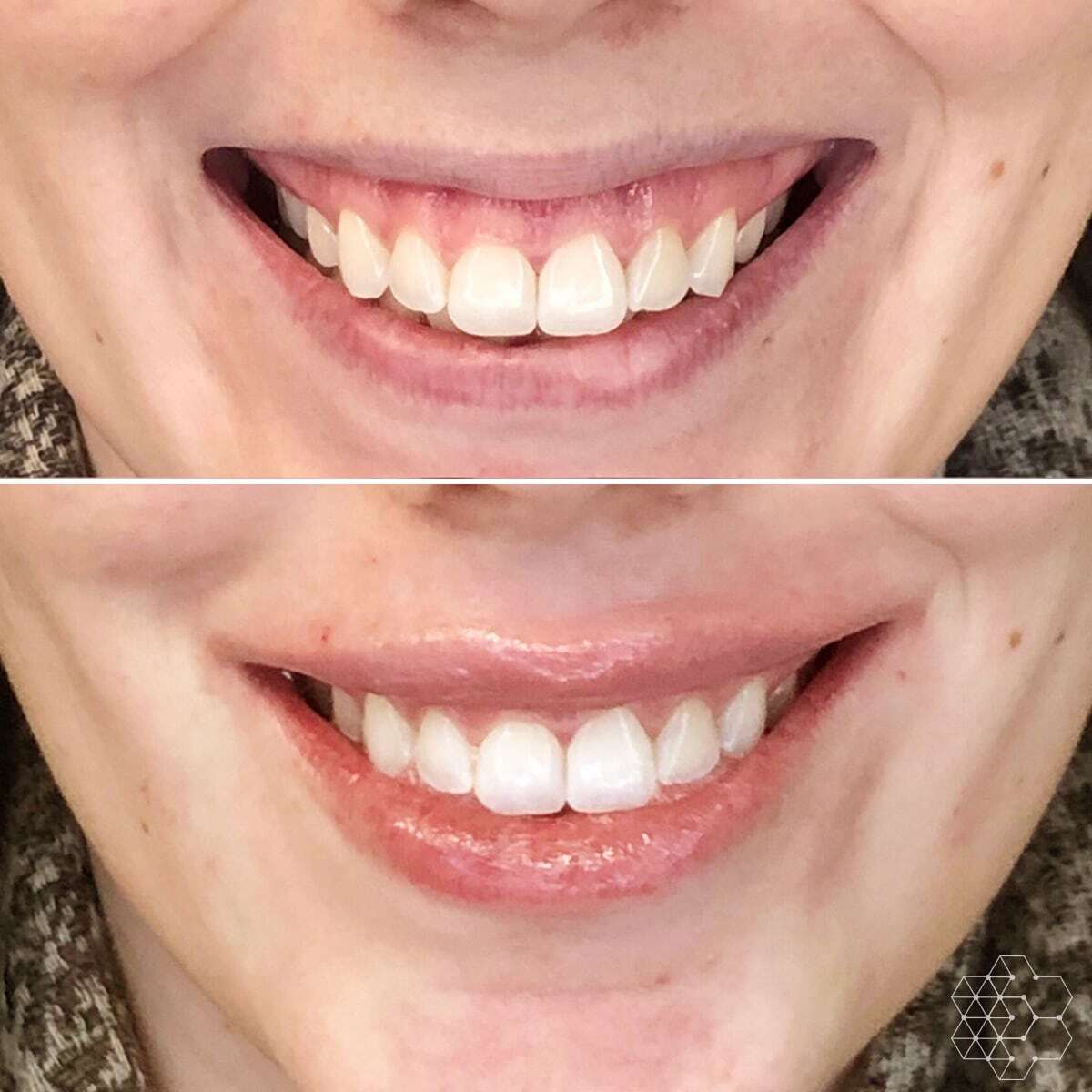 Gummy Smile Correction