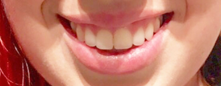 Gummy Smile