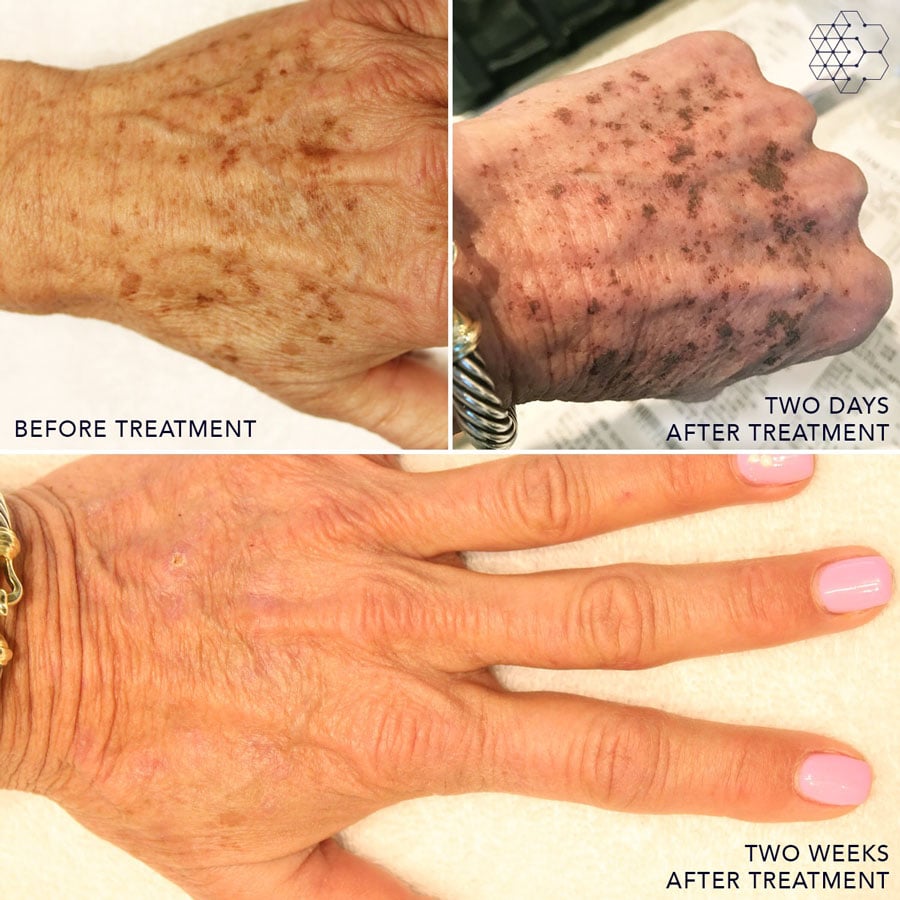 Treatment for Aging Hands in Vancouver