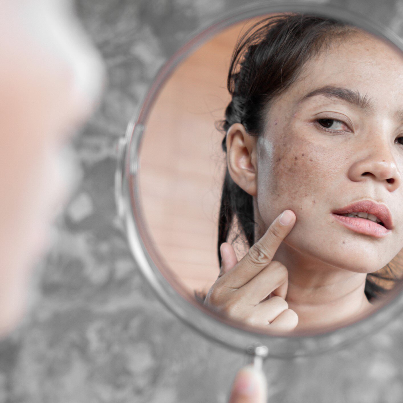 Difference Between Sunspots vs Freckles