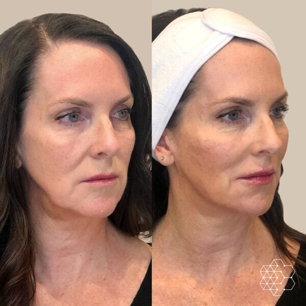 The JowlFix in Vancouver