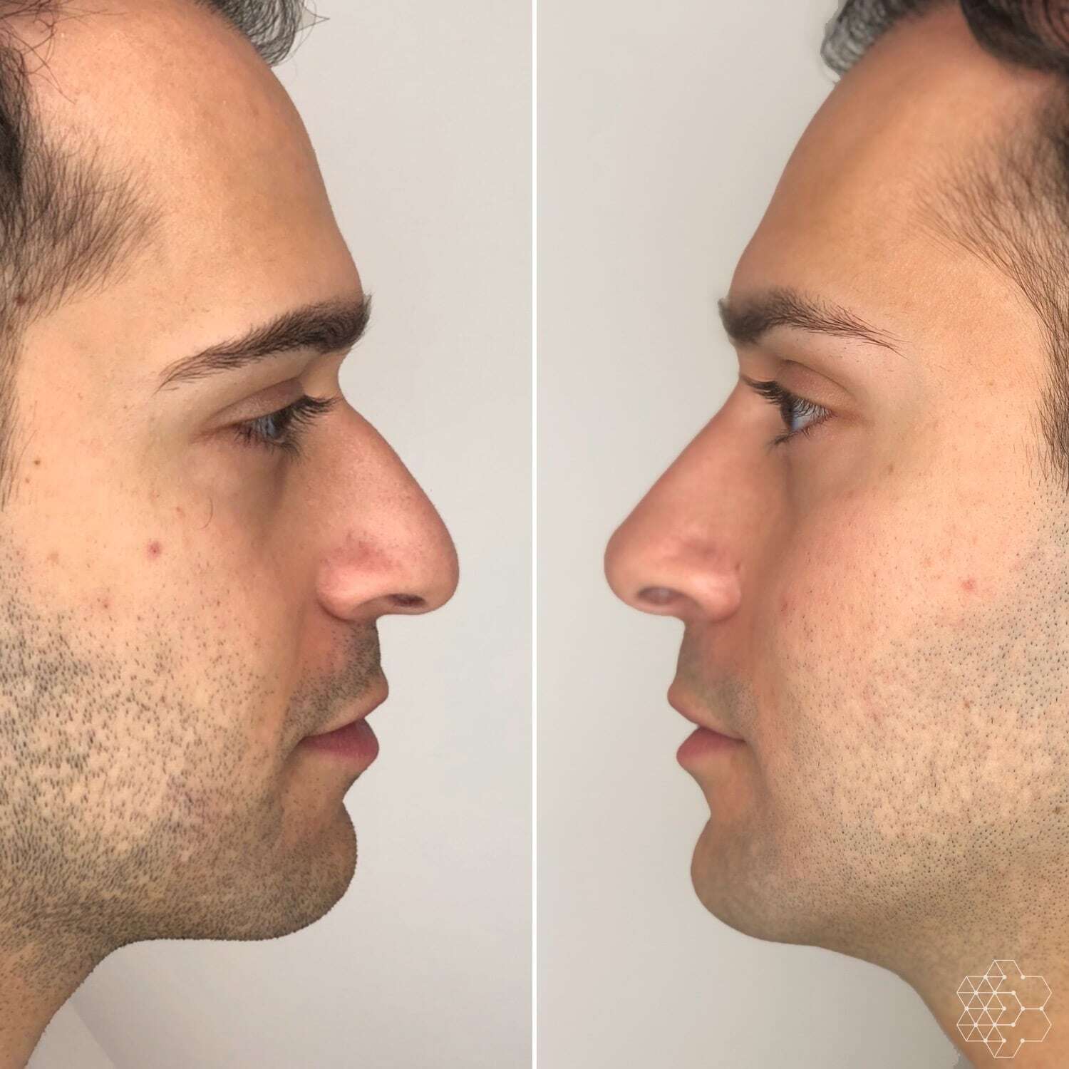 Non Surgical Nose Job