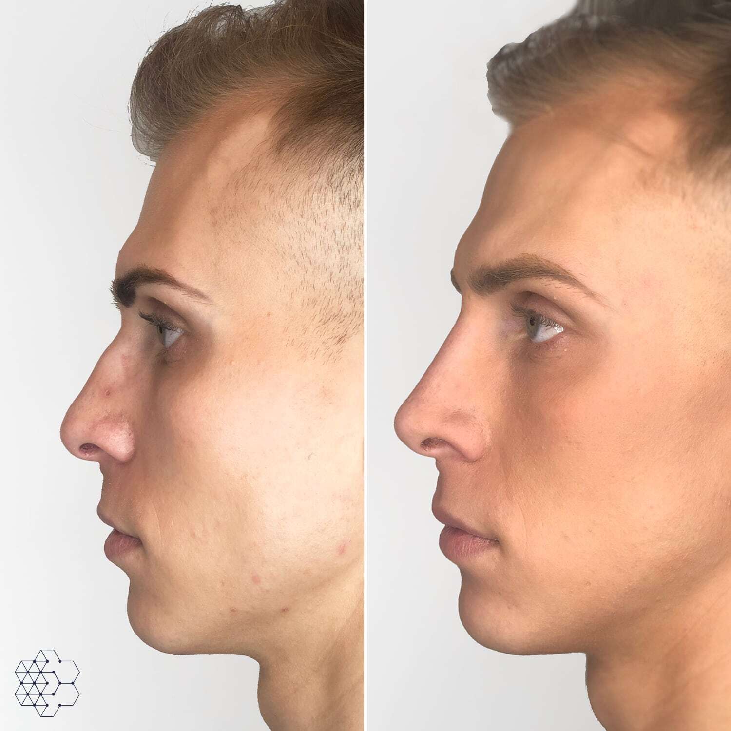 Non Surgical Nose Job