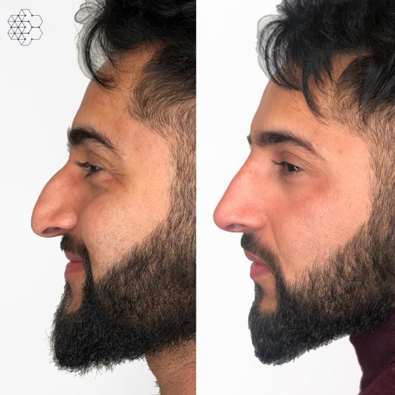 Non Surgical Nose Job
