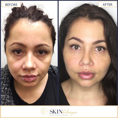 Soft lift procedure by Dr. Pavlou