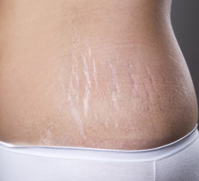 Stretch Mark Removal in Vancouver