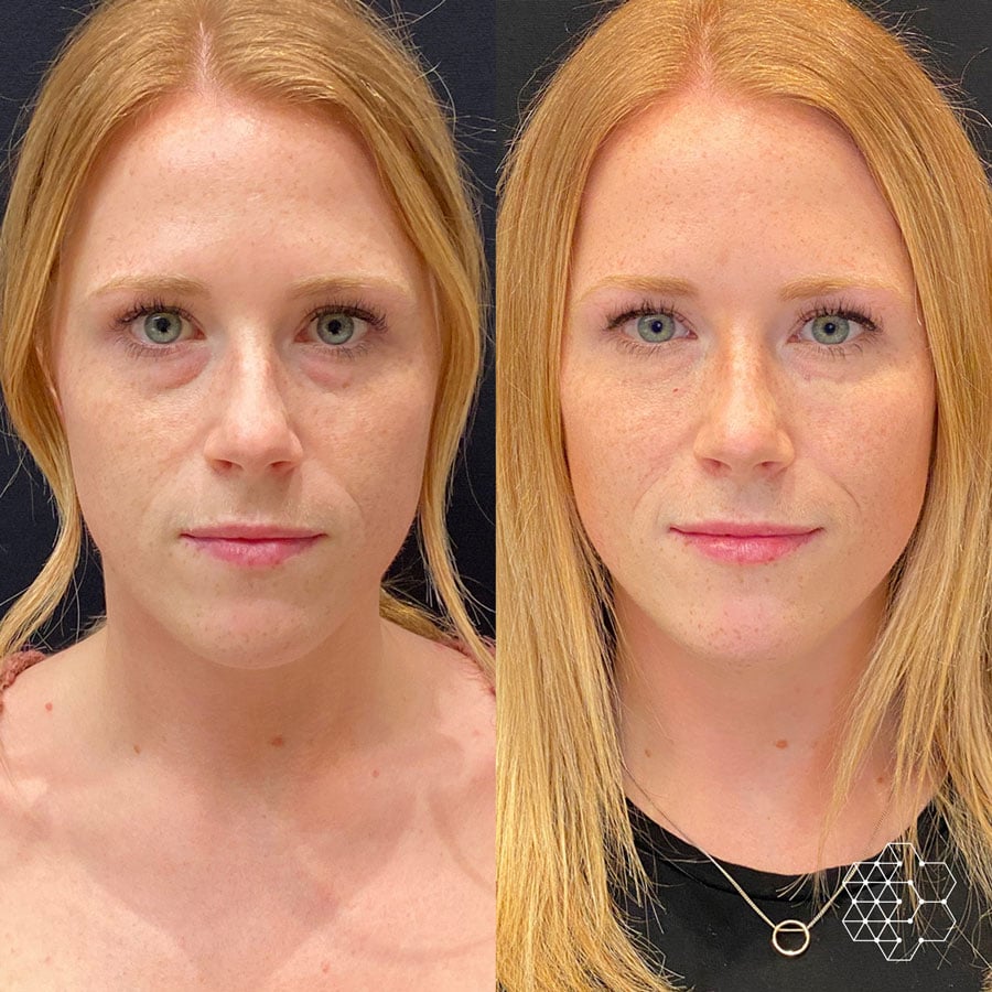 Tired Eye Treatments in Vancouver