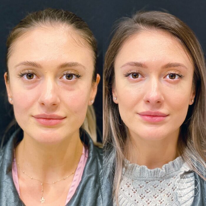 TiredEye™ Treatment