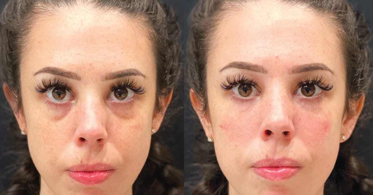 Top Three Solutions to Treat Under Eye Circles