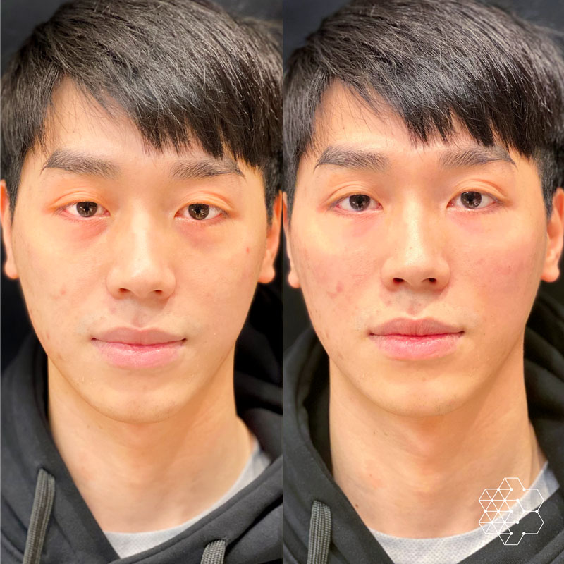 TiredEye™ Treatment