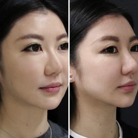 The JowlFix in Vancouver