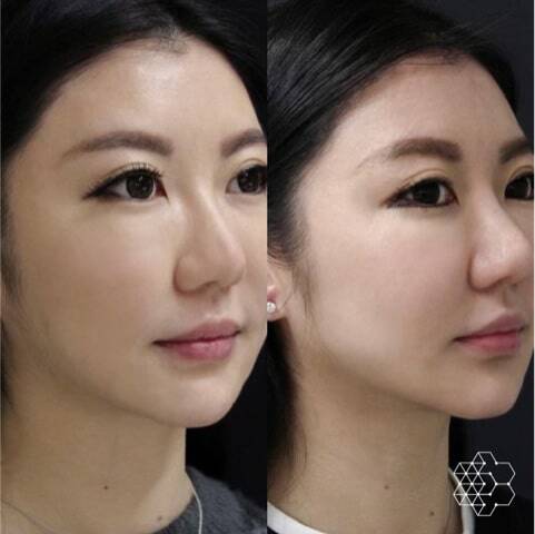 ultherapy before and after results at spa medica