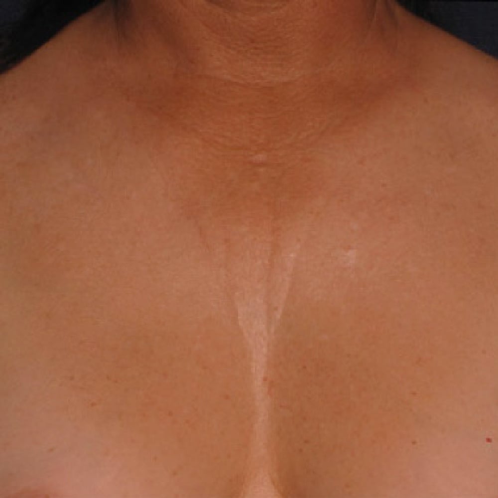 Décolletage
