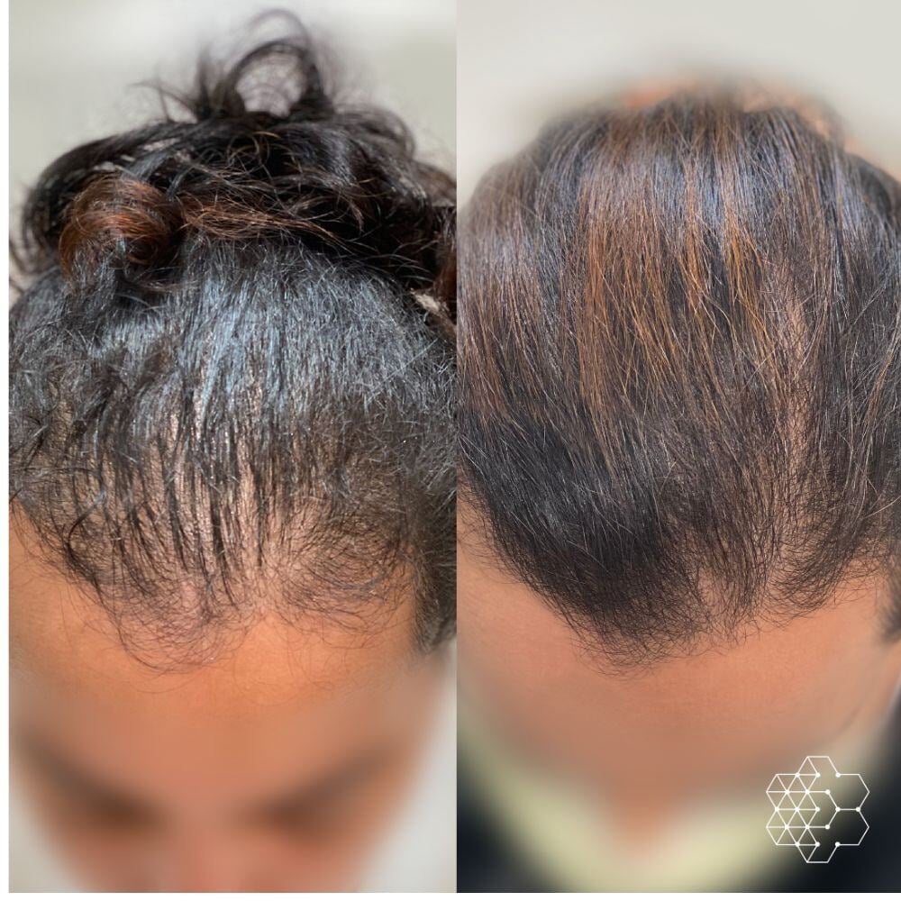 How to regrow thinning hair