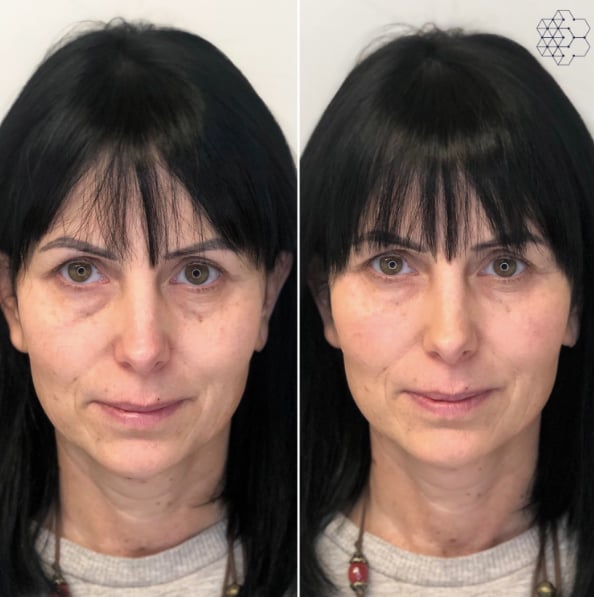 Volume Loss Treatments in Vancouver