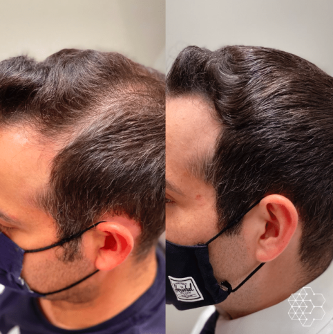 PRP Hair Restoration