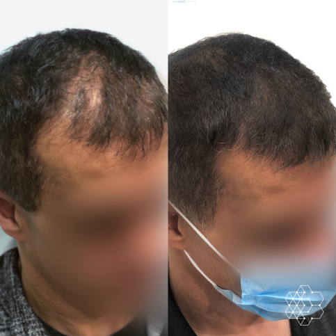 PRP Hair Restoration
