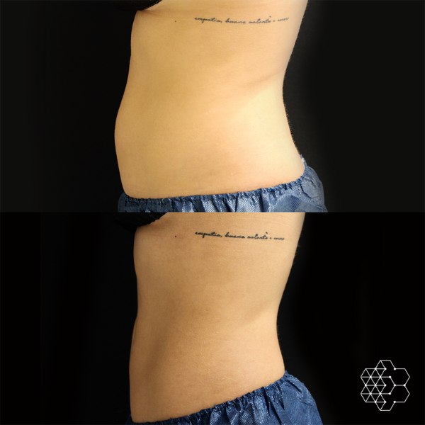 Ultimate Body Contouring Package