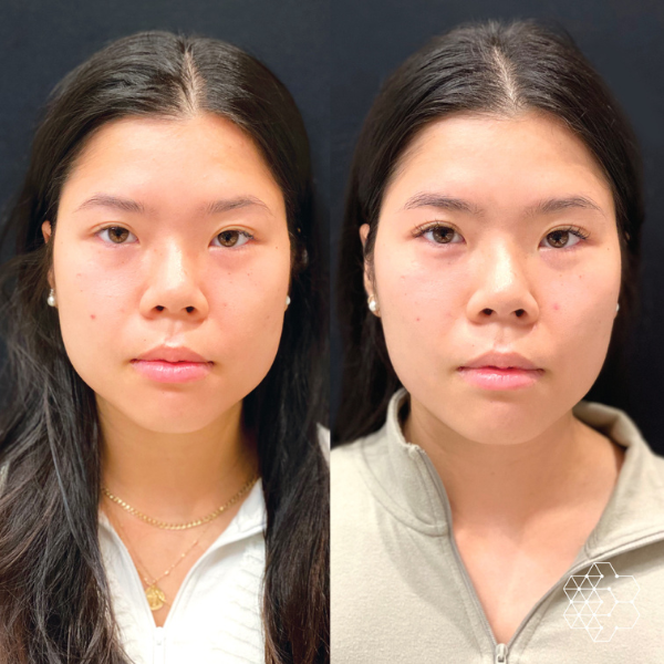 Facial Slimming