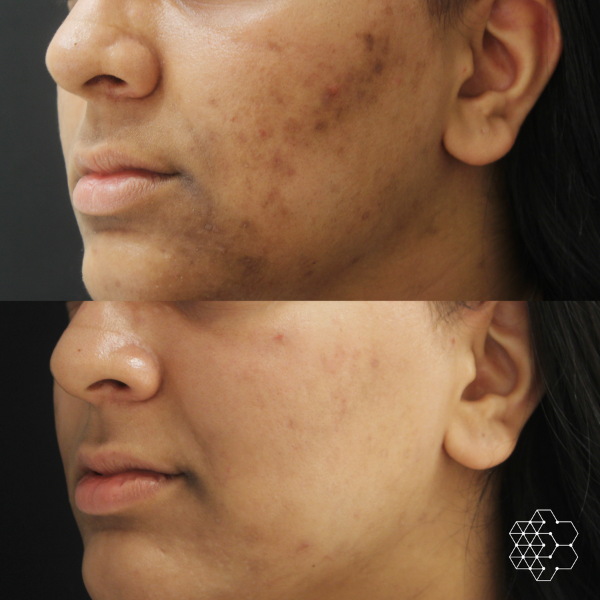 Forever Young BBL™