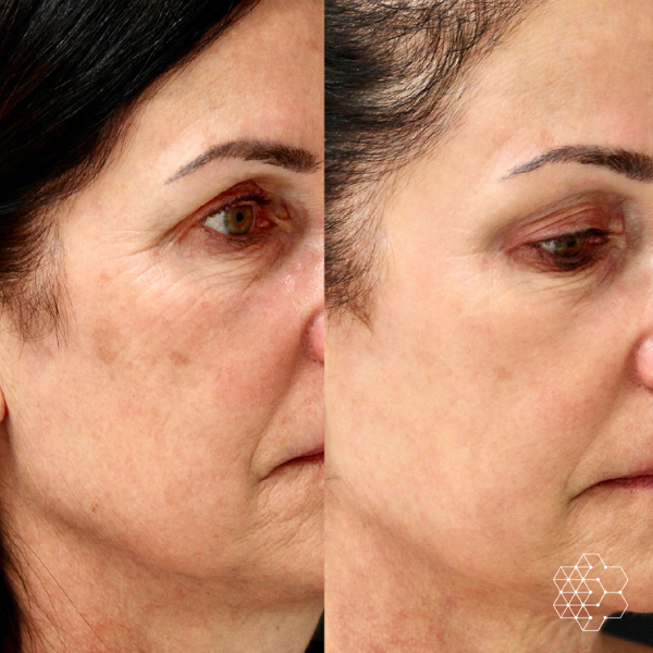 Forever Young BBL™