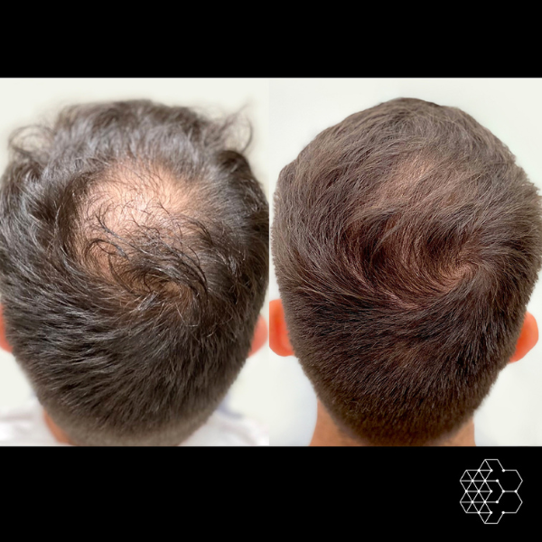 PRP Hair Restoration