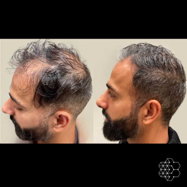 PRP Hair Restoration