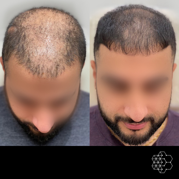 PRP Hair Restoration