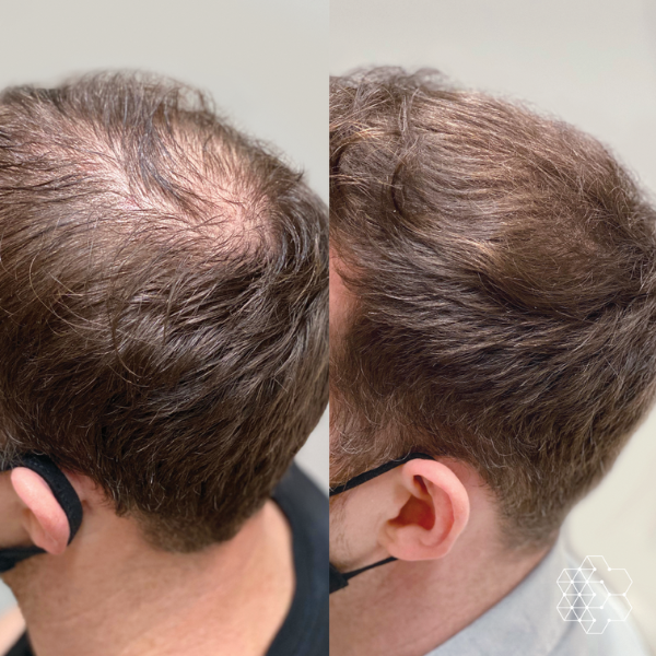 PRP Hair Restoration