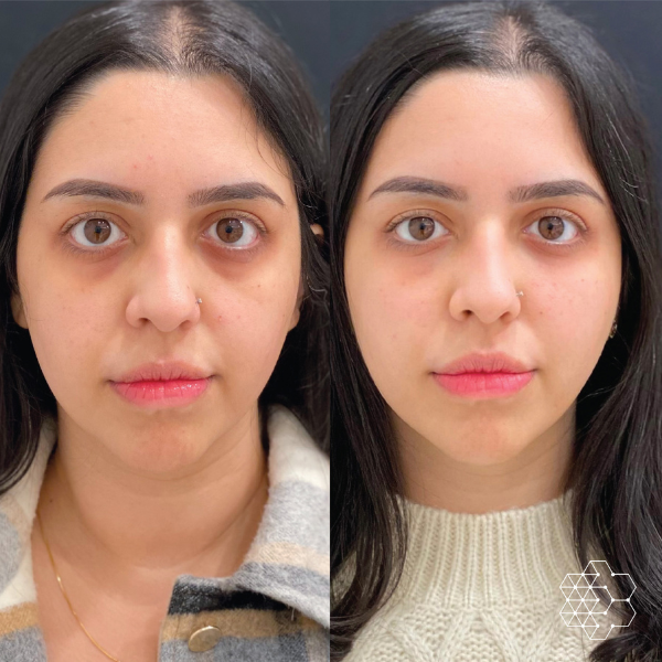 TiredEye™ Treatment