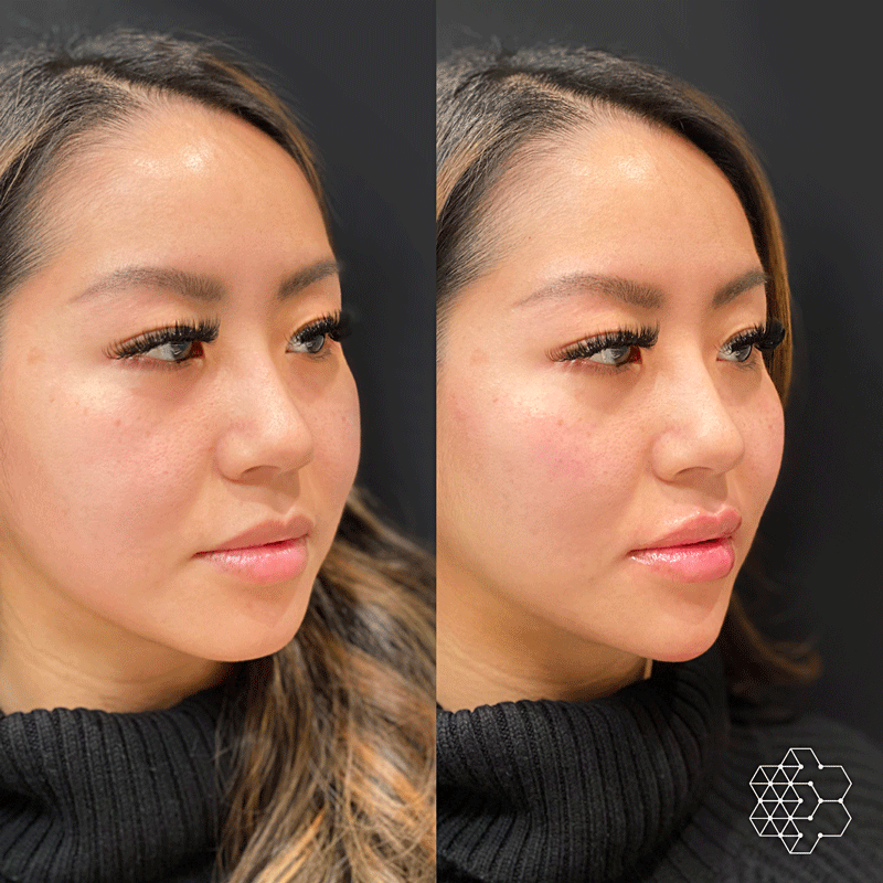 Chin and Jawline Enhancement