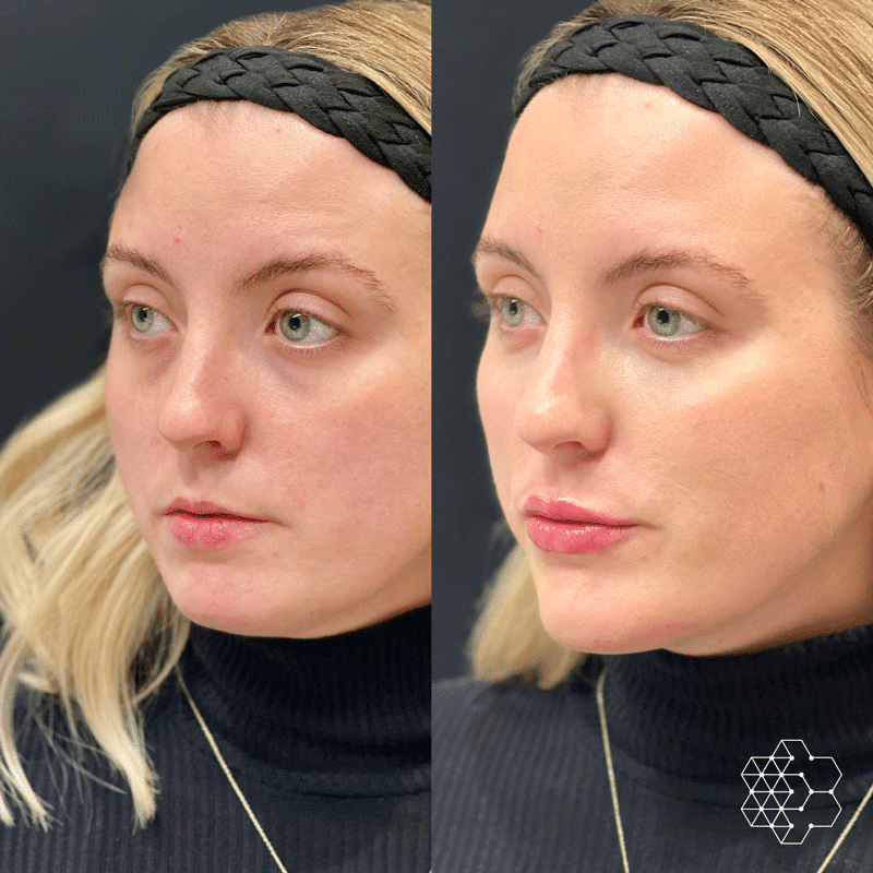 Chin and Lip Enhancement