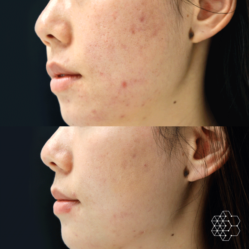 Halo and Forever Young BBL Laser Combination