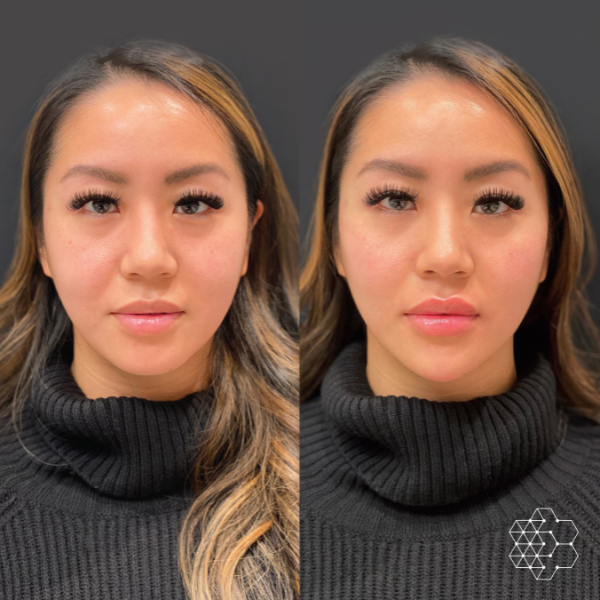 MystLift™ Beautification